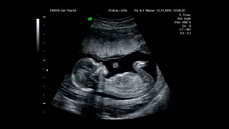 Guided ultrasound workflow